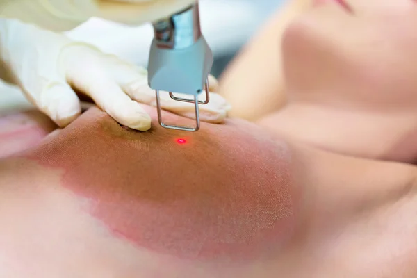 Laser menghapus tanda peregangan pada payudara kulit — Stok Foto