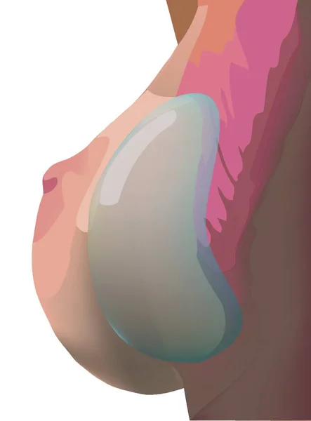 Косметическая Хирургия Женского Грудного Импланта — стоковый вектор