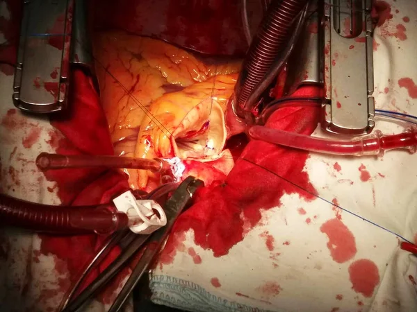 Ξυλοδαρμός γκρο πλαν ανθρώπινη καρδιά στο ανοιγμένο σεντούκι κατά τη διάρκεια της χειρουργικής επέμβασης — Φωτογραφία Αρχείου