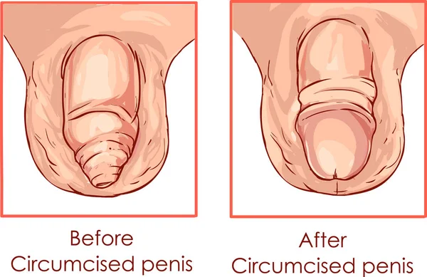 Ilustração da circuncisão do prepúcio do pênis — Vetor de Stock